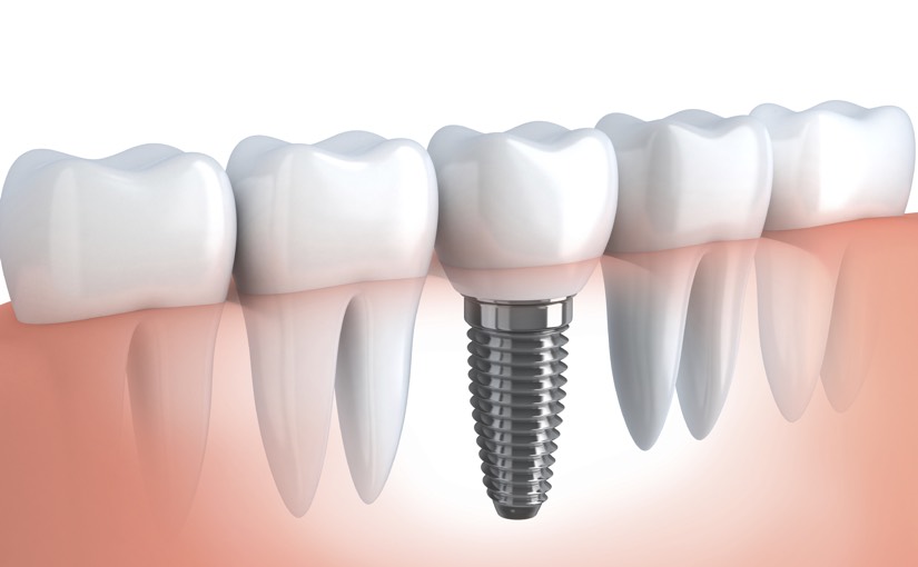 İnsan dişi implantını görsel olarak tanımlayan 3 boyutlu olarak hazırlanmış bir grafik.