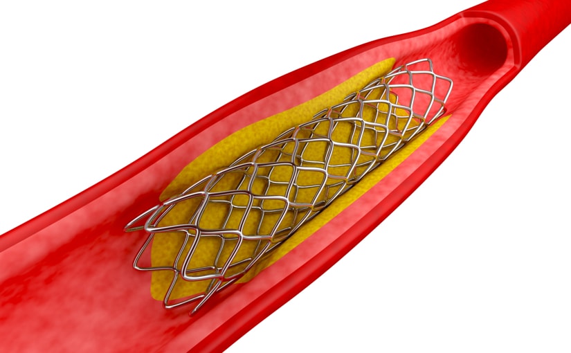 Stent